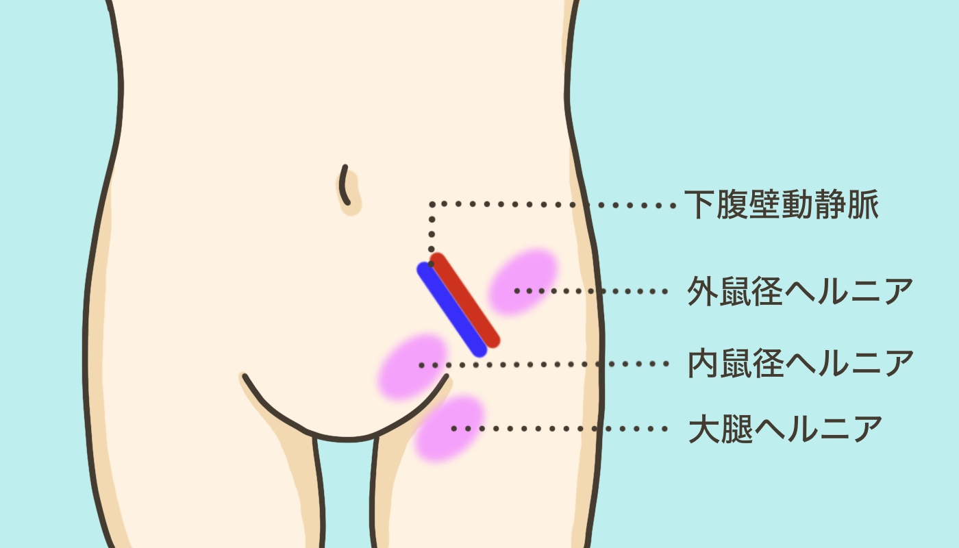 鼠径部ヘルニアの種類